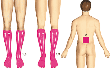 ДиаДЭНС-ПКМ и  Тяжесть в ногах, отеки, расширенные извитые вены, варикозные узлы (синдром хронической венозной недостаточности, варикозная болезнь нижних конечностей)